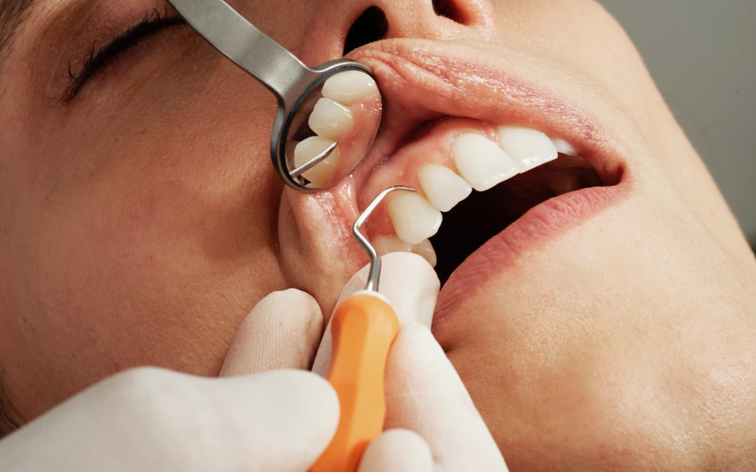 What You Need to Know About Periodontal Disease