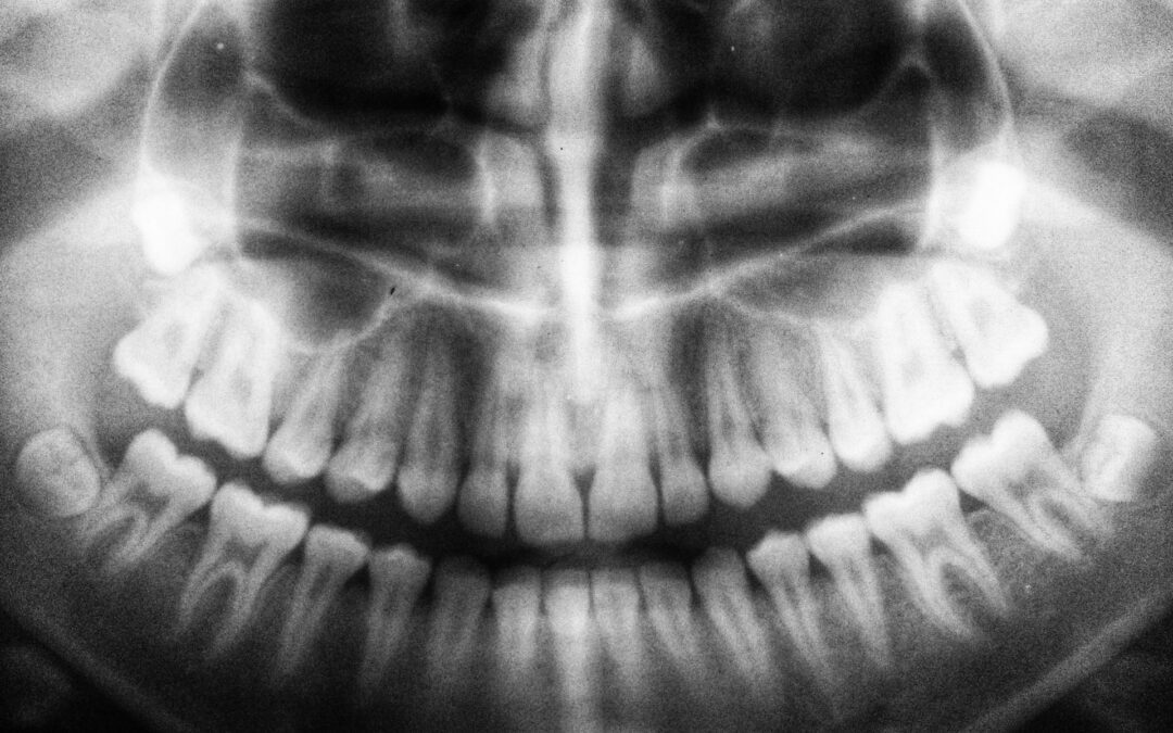 The Vital Role of X-Rays in Dental Care